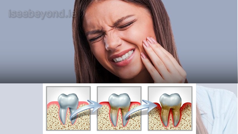 Illustration of tooth decay affecting enamel and gums.